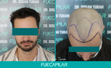 Dr. Turan - FUECAPILAR Clinic, NW II, 2439 grafts