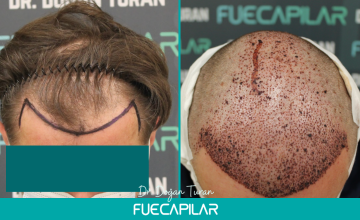 Dr. Turan - FUECAPILAR Clinic, NW IV, 3745 grafts