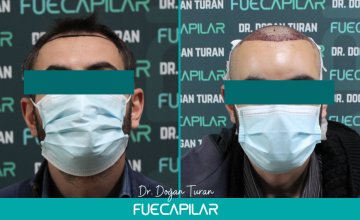 Dr. Turan - FUECAPILAR Clinic, NW III, 2306 grafts