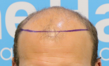 Dr Arshad patient - Hair Dr Clinic LEEDS, UK. Large head circumference. FUE 5122 grafts (over 2 surgeries) - planning a third surgery.