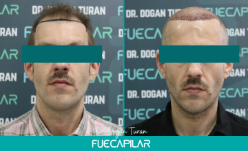 Dr. Turan - FUECAPILAR Clinic, NW IVa, 3957 grafts