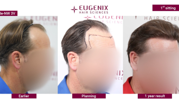 EUGENIX HAIR SCIENCE - DR. PRADEEP SETHI - A PERFECT USE OF 3287 GRAFTS