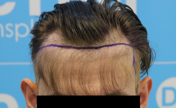 What do you think of this repair case? - Dr Arshad hairline repair, hairline grafts punched out and re-implanted! From Jan 2022 (10 months)
