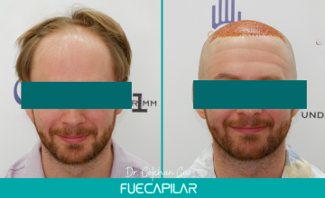 Dr. Gur - FUECAPILAR Clinic, Norwood IIIa 3265 grafts