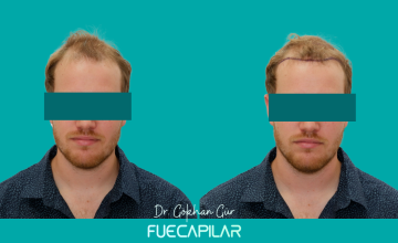 Dr. Gur - FUECAPILAR Clinic, Norwood V, only 2843 grafts FULL COVERAGE