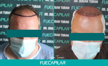Dr. Turan - FUECAPILAR Clinic, NW IVa with diffuse thinning in the mid scalp and upper vertex, 4847 grafts (32 months results)