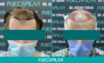 Dr. Turan - FUECAPILAR Clinic, Norwood III, 2404 grafts