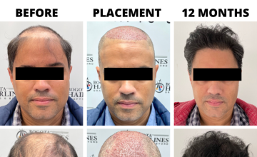 Bogota Hairlines - Dr Sergio Camacho 4156 Grafts NO MORE HAIR SYSTEM!