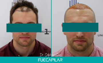 Dr. Gur - FUECAPILAR Clinic, Norwood IIIa, 2580 grafts