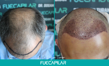 Dr. Turan - FUECAPILAR Clinic, NW Va-VI, 2 surgeries approach, 6.196 grafts overall