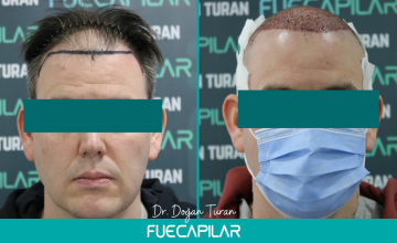 Dr. Turan - FUECAPILAR Clinic, NW IV with thinning in the mid scalp, 4222 grafts