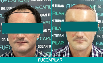 Dr. Turan - FUECAPILAR Clinic, Norwood IV, 4142 grafts