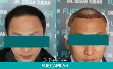 Dr. Turan - FUECAPILAR Clinic, Diffuse thinning across the entire scalp, 3003 grafts