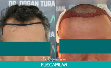 Dr. Turan - FUECAPILAR Clinic, Norwood III with diffuse thinning in mid scalp and crown, 3643 grafts