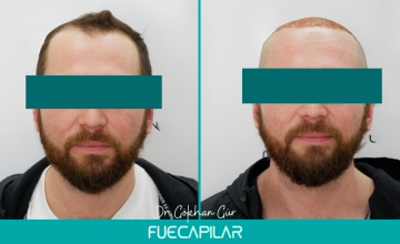 Dr. Gur - FUECAPILAR Clinic, Norwood IIIv, 3034 grafts