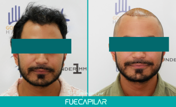 Dr. Gur - FUECAPILAR Clinic, Norwood IV with diffuse thinning in the midscalp - 3156 grafts