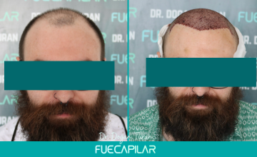 Dr. Turan - FUECAPILAR Clinic, NW Va-VI (2 surgeries approach), 4167 grafts