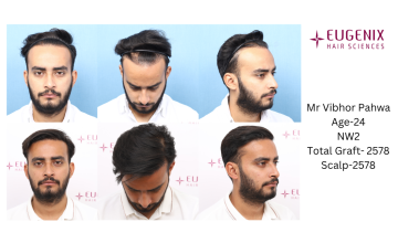 CORRECTIVE SURGERY | HAIRLINE AUGMENTATION & FTA | EUGENIX HAIR SCIENCES | DR. ARIKA BANSAL