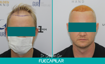 Dr. Gur - FUECAPILAR Clinic, NW III-IIIa, 3012 grafts