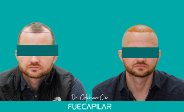 Dr. Gur - FUECAPILAR Clinic, Norwood IV, 3019 grafts