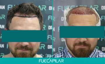 Dr. Turan - FUECAPILAR Clinic, NW III, 2937 grafts