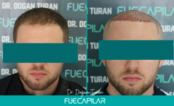 Dr. Turan - FUECAPILAR Clinic, NW IIIv, 2774 grafts