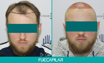 Dr. Gur - FUECAPILAR Clinic, NW III-IIIa, 2812 grafts