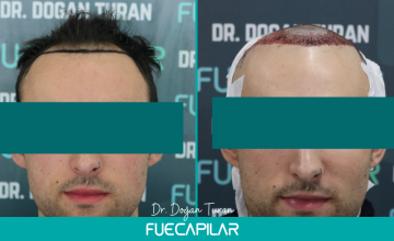 Dr. Turan - FUECAPILAR Clinic, NW III, 2468 grafts