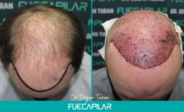 Dr. Turan - FUECAPILAR Clinic, NW VI, 2 surgeries approach, 7903 grafts overall