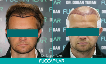 Dr. Turan - FUECAPILAR Clinic, NW II, 3340 grafts