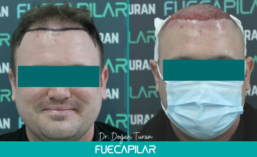 Dr. Turan - FUECAPILAR Clinic, NW III with diffuse thinning in the mid scalp and crown, 2859 grafts