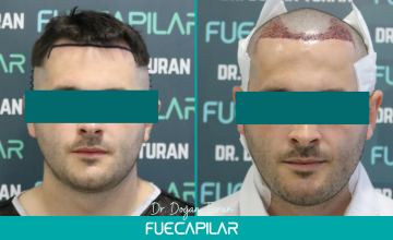 Dr. Turan - FUECAPILAR Clinic, NW III, 2091 grafts