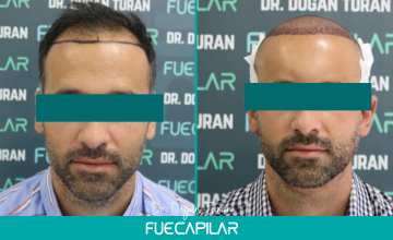 Dr. Turan - FUECAPILAR Clinic, NW Va progression, 4072 grafts (including 633 from the beard)