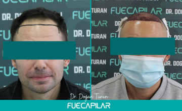Dr. Turan - FUECAPILAR Clinic, Norwood III, 2636 grafts 24 month results