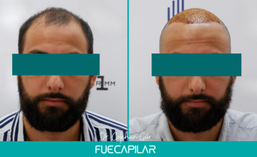 Dr. Gur - FUECAPILAR Clinic, Norwood Va-VI, 3029 grafts (Hairline, Frontal and Midscalp)