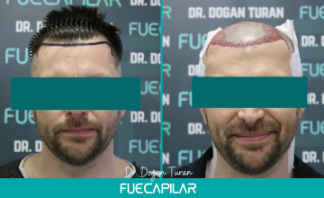 Dr. Turan - FUECAPILAR Clinic, Norwood II-III, 2079 grafts