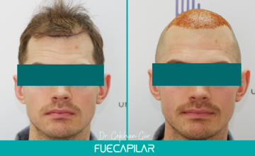 Dr. Gur - FUECAPILAR Clinic, Norwood III-IIIa 3006 grafts