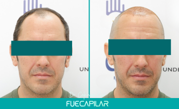 Dr. Gur - FUECAPILAR Clinic, Norwood Va, 3317 grafts