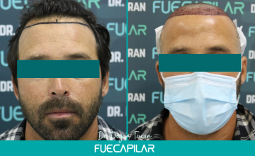 Dr. Turan - FUECAPILAR Clinic, NW IV, 3918 grafts