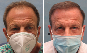 Norwood 6 FUT 3,036 Grafts - Dr. Robert Bernstein