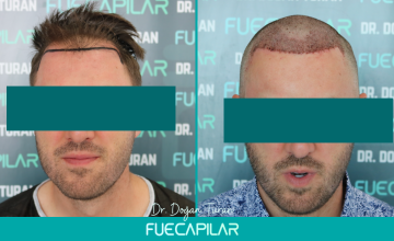 Dr. Turan - FUECAPILAR Clinic, NW IV, 3915 grafts