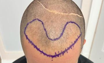 11 week hair transplant update with dr Manish Mittal