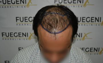 Dr. Munib Ahmad - 2560g - How a insecure guy with a hairsystem turned into a confident young man  - FueGenix - The Netherlands