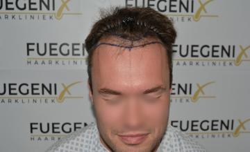 Dr. Munib Ahmad - 2189g - From Hat 🎩 Damon to Matt Damon - Brown Hair Hairline - FueGenix - The Netherlands