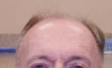 Michael Vories, MD 5000 FUE Grafts