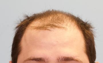 Michael Vories, MD FUE 5000 Grafts