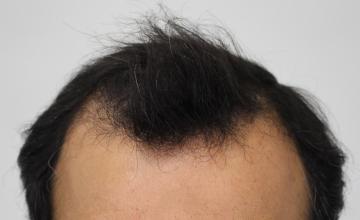 Dr. Rahal / 2561 graft FUE / NW 3 / 11 months post-op