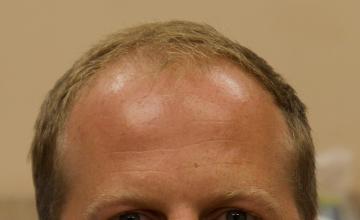 Michael Vories, MD FUE 2000 Grafts