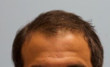 Michael Vories, MD FUE 4000 Grafts