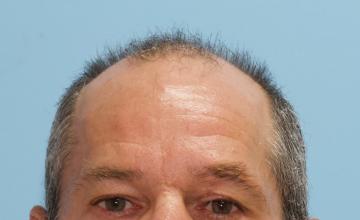 Michael Vories, MD 5000 FUE Grafts